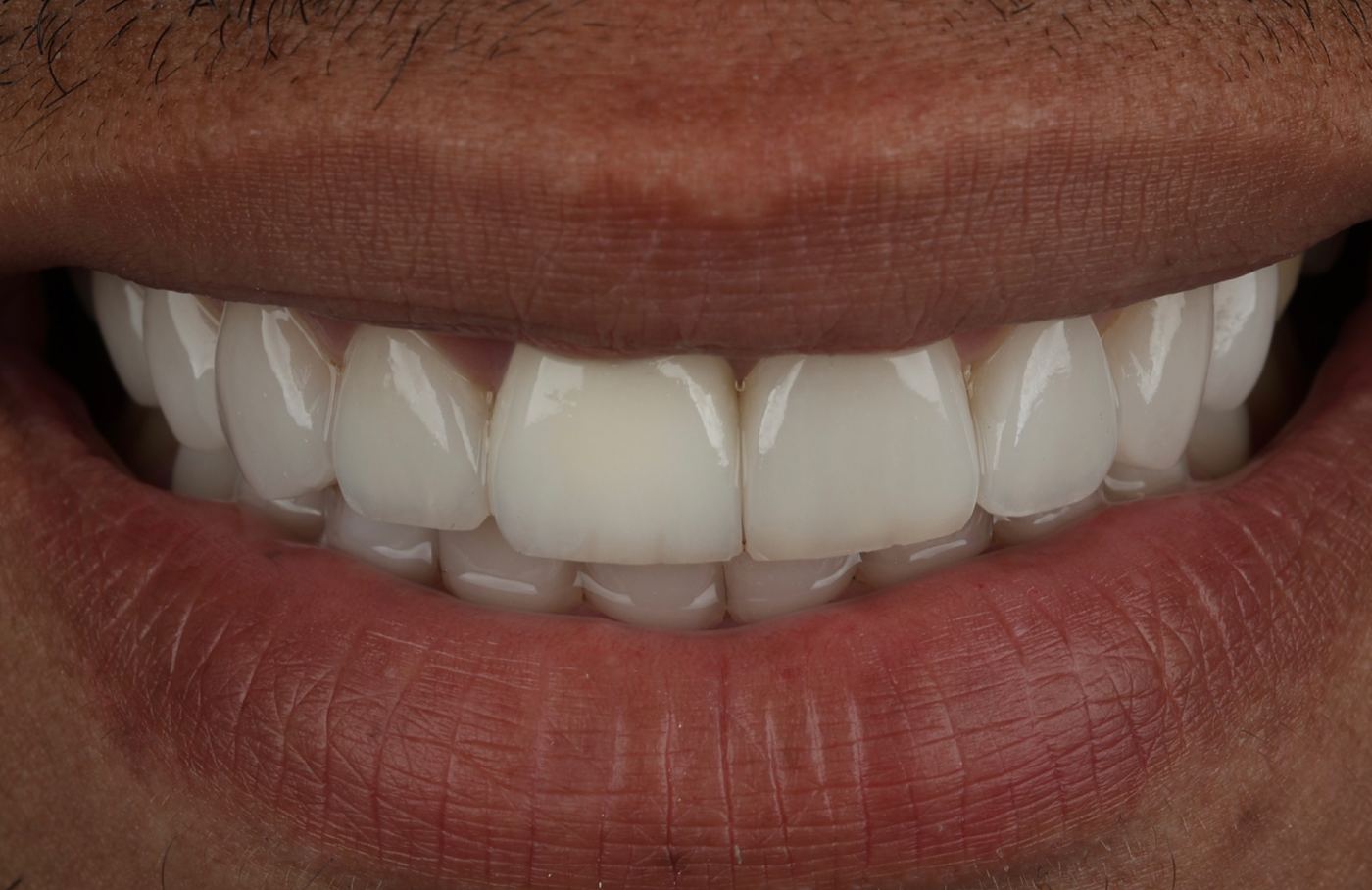 After: the same smile with veneers by Dr. Daniel